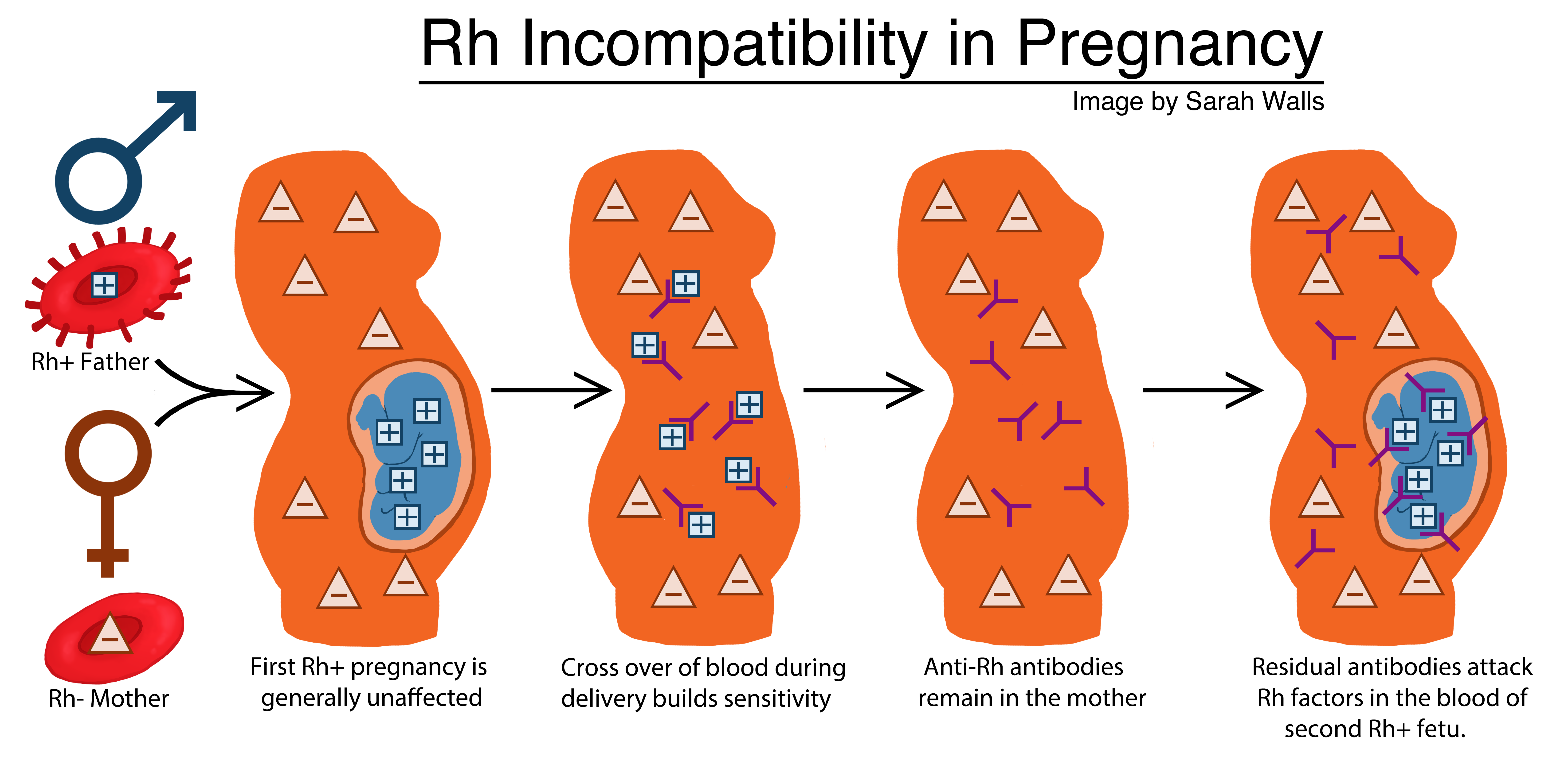 An illustration of Rh incompatibility in pregnancy