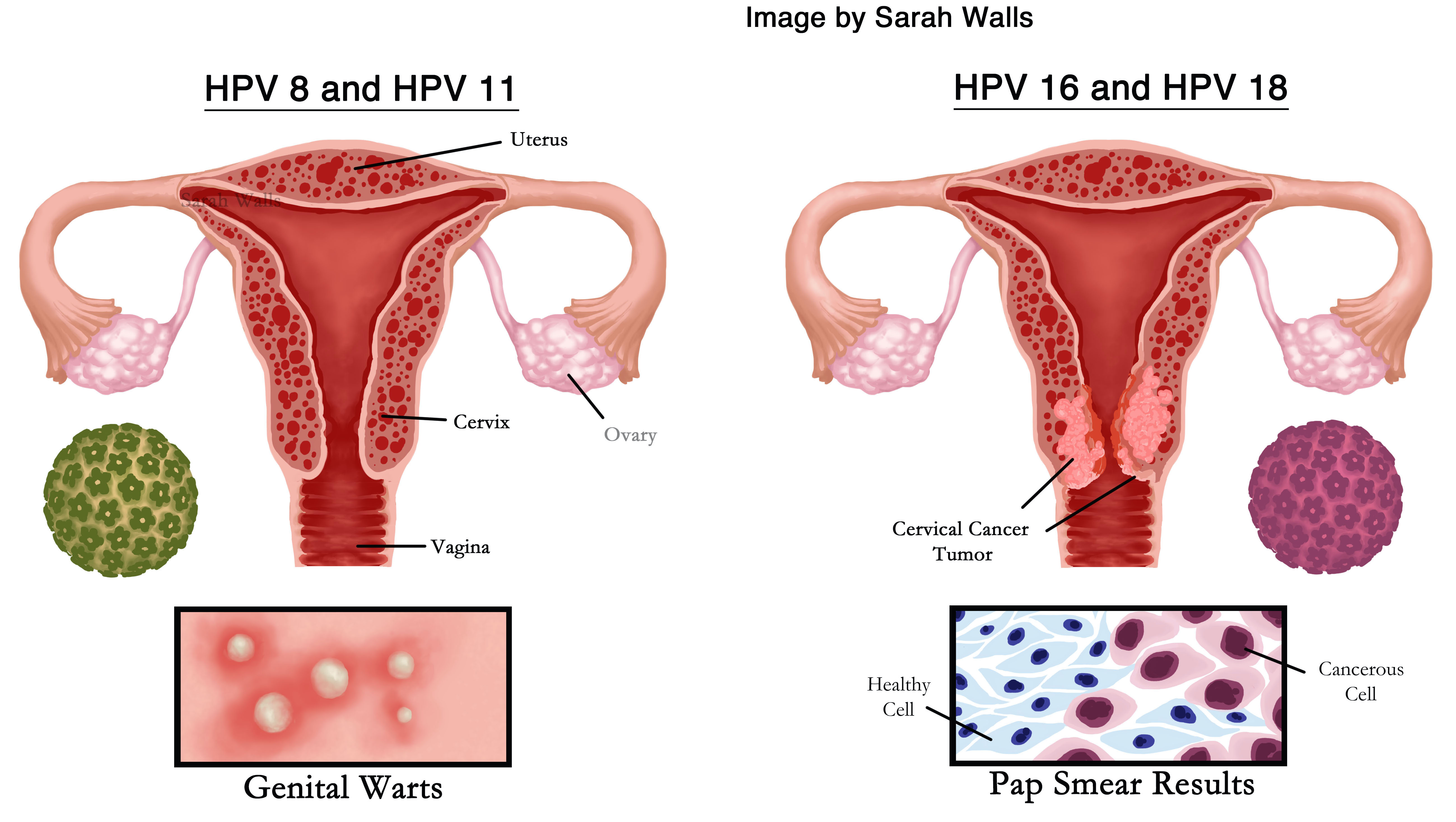 an illustration of HPV