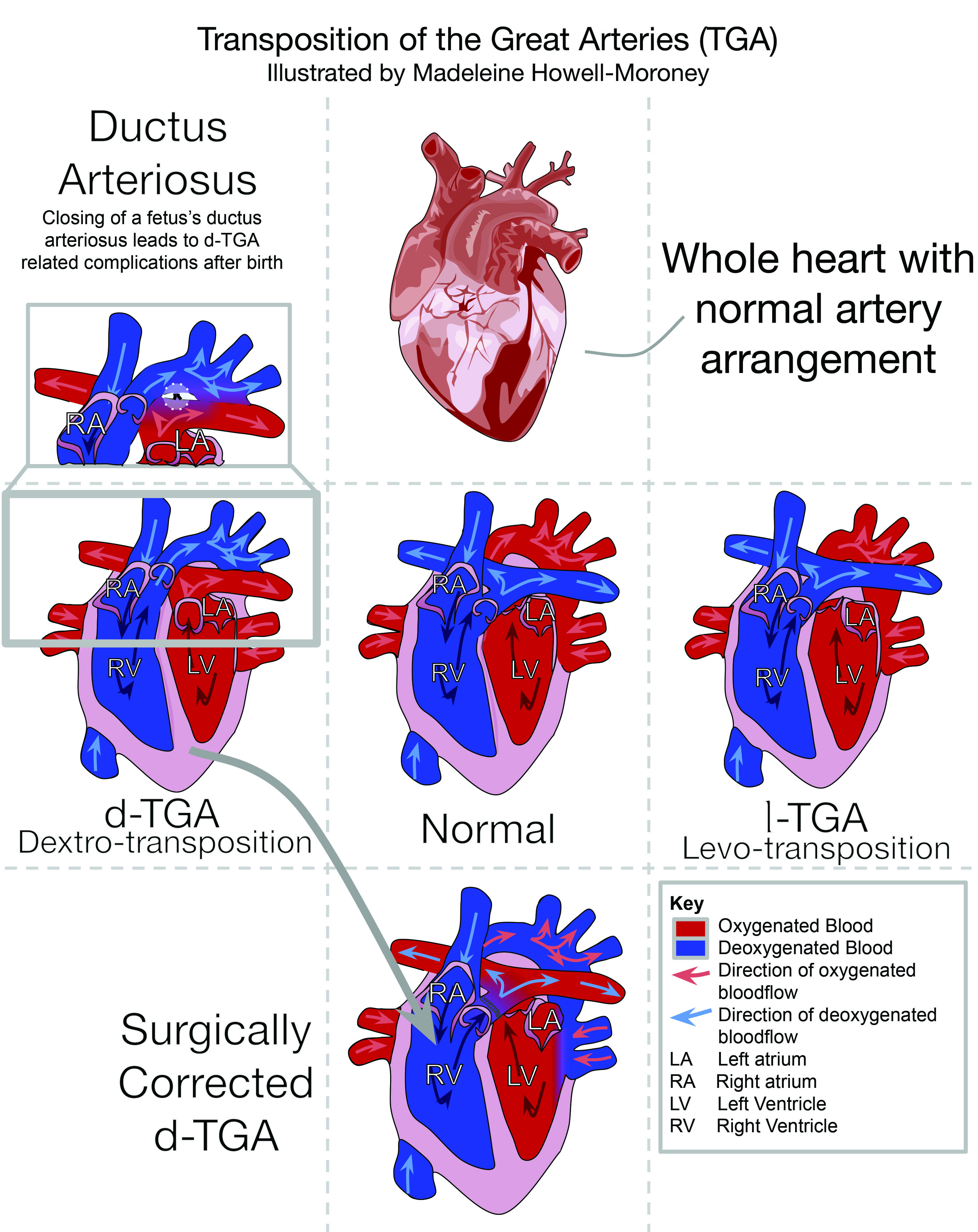 illustration of transposition of the arteries