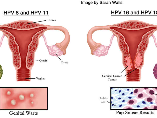 Human Papillomavirus HPV Strains 6 and 11 and Strains 16 and 18